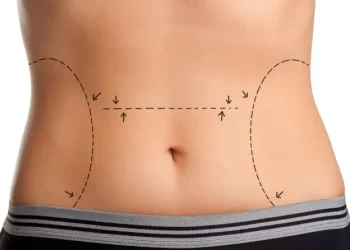 Beyond the Tummy Tuck: Understanding the Benefits and Risks of Abdominoplasty