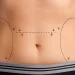 Beyond the Tummy Tuck: Understanding the Benefits and Risks of Abdominoplasty