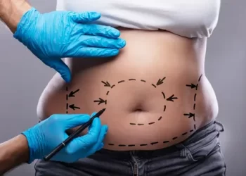 How to Get Abs After a Tummy Tuck